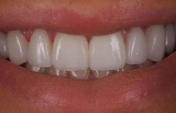 Photo after the dental treatment