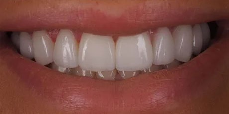 Photo after the dental treatment