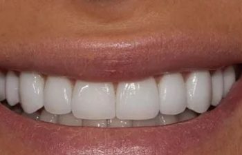 Photo after the dental treatment