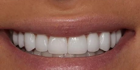 Photo after the dental treatment