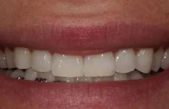 Photo after the dental treatment