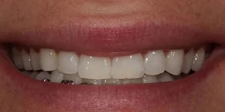 Photo after the dental treatment