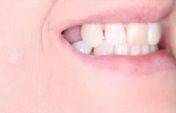 Photo before the dental treatment