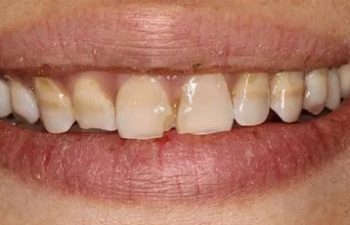 Photo before the dental treatment