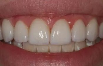 Photo after the dental treatment