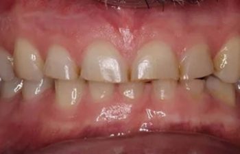 Photo before the dental treatment