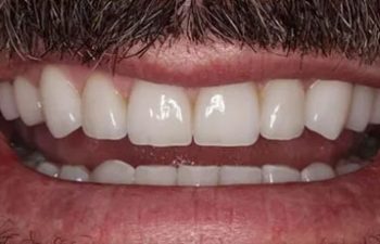 Photo after the dental treatment