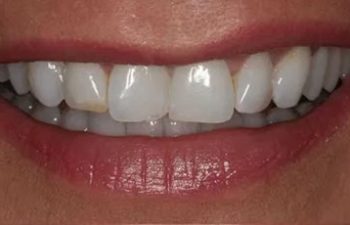 Photo before the dental treatment