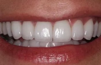 Photo after the dental treatment