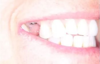 Photo before the dental treatment