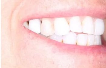 Photo after the dental treatment